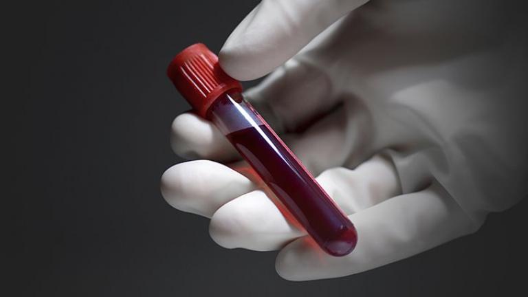 Αιματολογική εξέταση που ανιχνεύει το μελάνωμα σε αρχικά στάδια ανακάλυψαν επιστήμονες