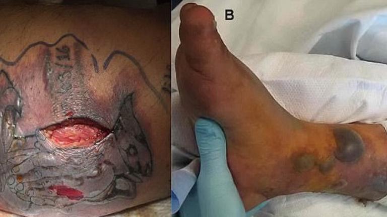 Την ζωή του έχασε 31χρονος από σαρκοφάγο βακτήριο – Μολύνθηκε το φρέσκο τατουάζ του