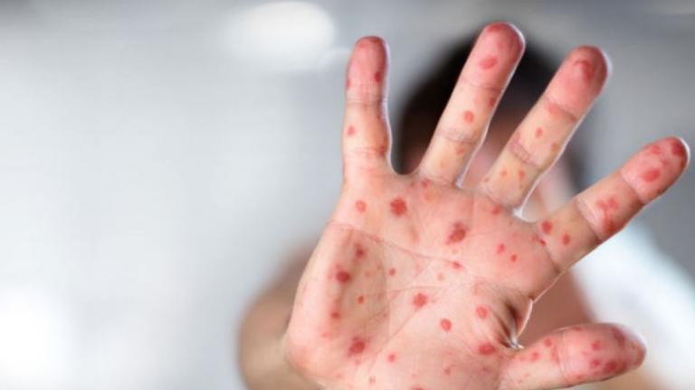 Προβληματισμός του ΚΕΕΛΠΝΟ για τα αυξανόμενα περιστατικά ιλαράς