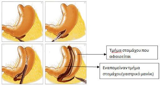 Ποια χειρουργική επέμβαση έκανε ο Πάνος Καμμένος και έχασε 55 κιλά
