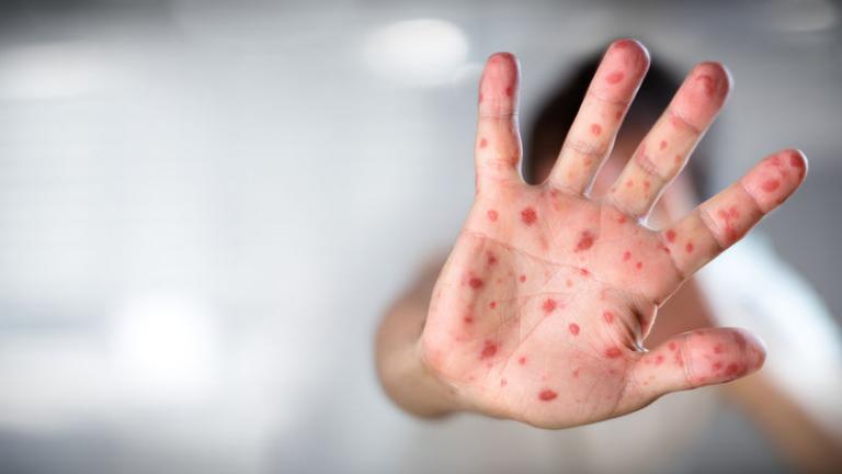 Έξι γιατροί δημόσιων νοσοκομείων έχουν αρρωστήσει με ιλαρά