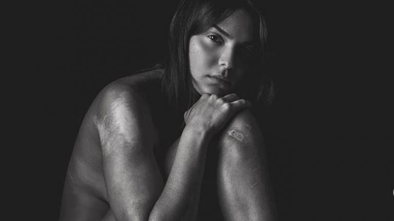 Βρισηίδα Ανδριώτου: Οι γυμνές φωτογραφίες και τα σημάδια από το τροχαίο 