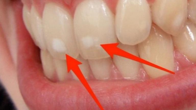 Πού οφείλονται ΑΥΤΑ τα λευκά σημάδια στα δόντια – Τι πρέπει να κάνετε