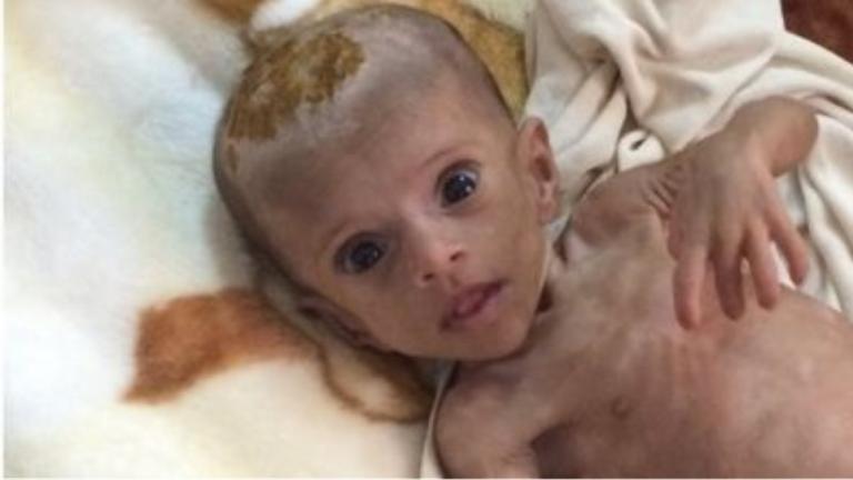 Υεμένη - ΟΗΕ: 14 εκατομμύρια άνθρωποι κινδυνεύουν να πεθάνουν από πείνα εν μέσω του πολέμου 