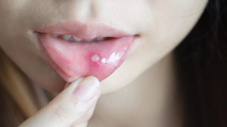 Οι 7 κίνδυνοι για την υγεία που αποτυπώνονται στο στόμα