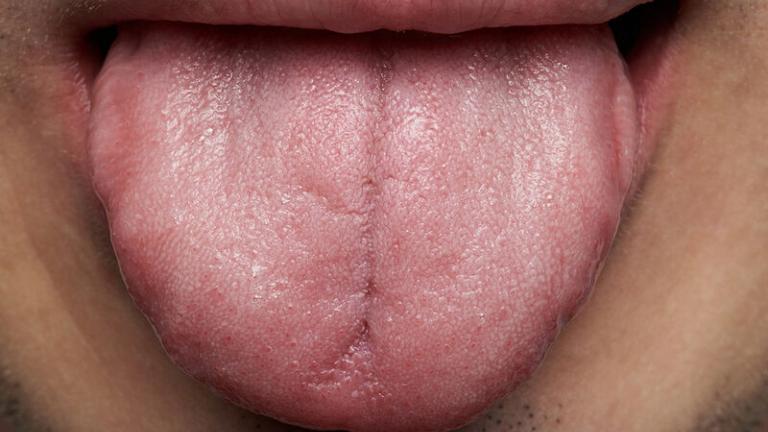 Τι δείχνει το χρώμα της γλώσσας για την υγεία σας 