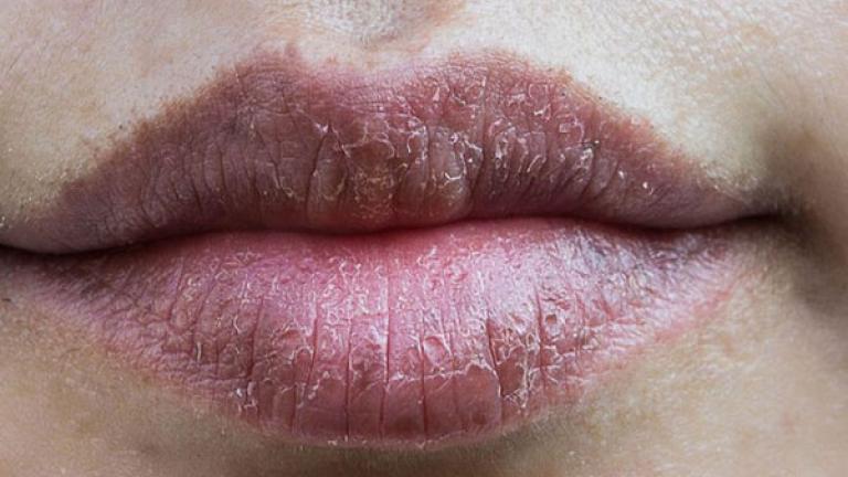 Σκασμένα χείλη τον χειμώνα: 9 συμβουλές για να τα θεραπεύσετε
