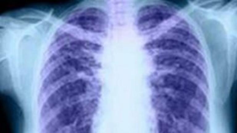 Αυξήθηκαν τις τελευταίες τρεις δεκαετίες οι θάνατοι λόγω χρόνιων παθήσεων των πνευμόνων