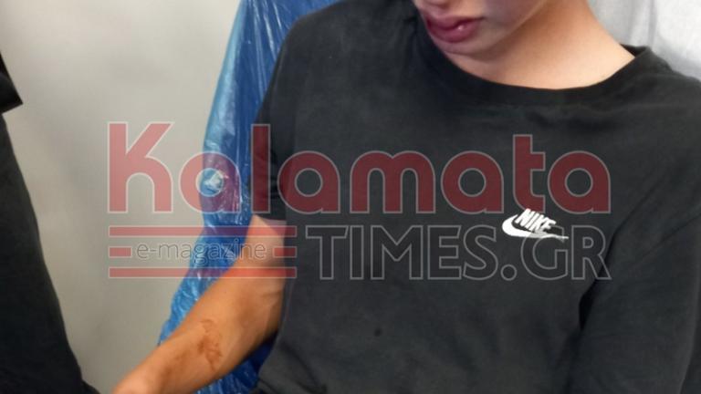 Άγριος ξυλοδαρμός 16χρονου από συμμορία ανηλίκων στην Καλαμάτα 