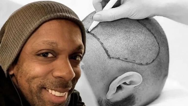 τουρκια μεταμοσχευση μαλλιων