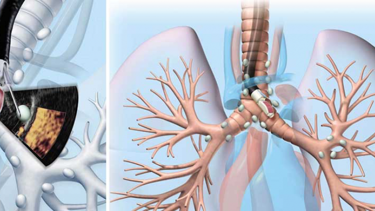 Eπαναστατική τεχνική που συμβάλει στη διάγνωση του καρκίνου του πνεύμονα χωρίς χειρουργείο