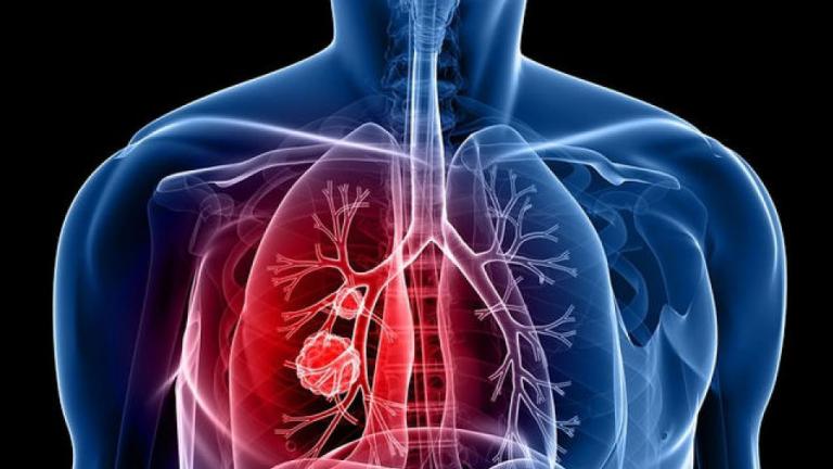 Τι μπορεί να προκαλέσει καρκίνο του πνεύμονα