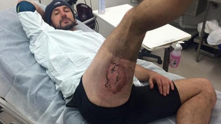 Ποδηλάτης πήρε φωτιά όταν πήρε φωτιά το iPhone του